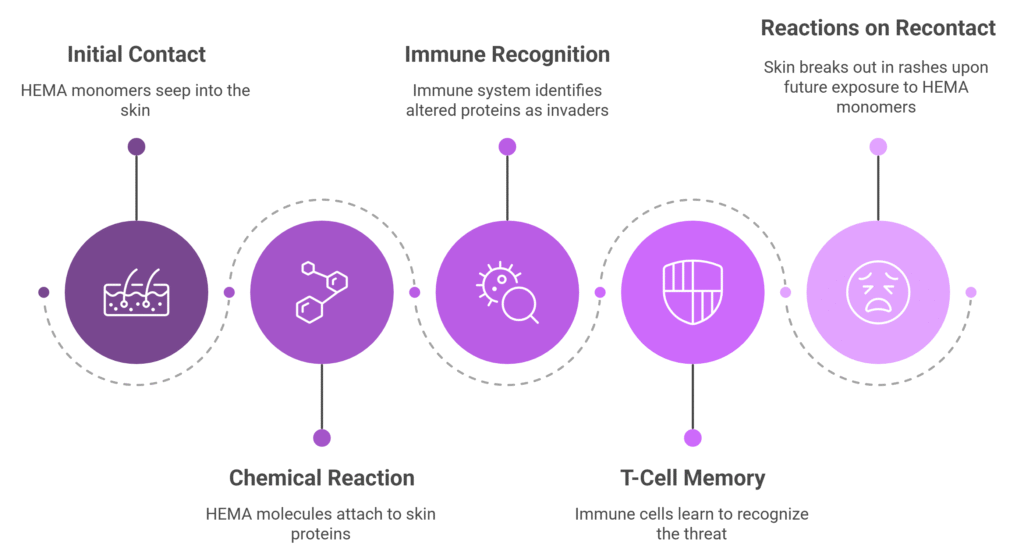 A five-step infographic illustrating the mechanism of allergic contact dermatitis from acrylate monomers like HEMA. The first step shows monomers penetrating the skin at the fingertips. The second step depicts a chemical reaction where monomers bind to skin proteins, altering their structure. In the third step, the immune system recognizes these altered proteins as foreign, triggering an immune alert. The fourth step highlights T-cell memory formation, preparing the body for future defense. The final step visualizes a subsequent exposure leading to red, itchy, and blistering skin reactions—even from minimal contact.