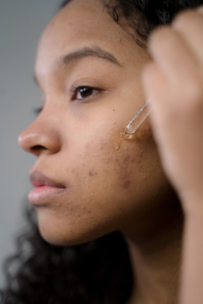 Green tea can sit beside an established acne treatment. I would not build the routine around it.